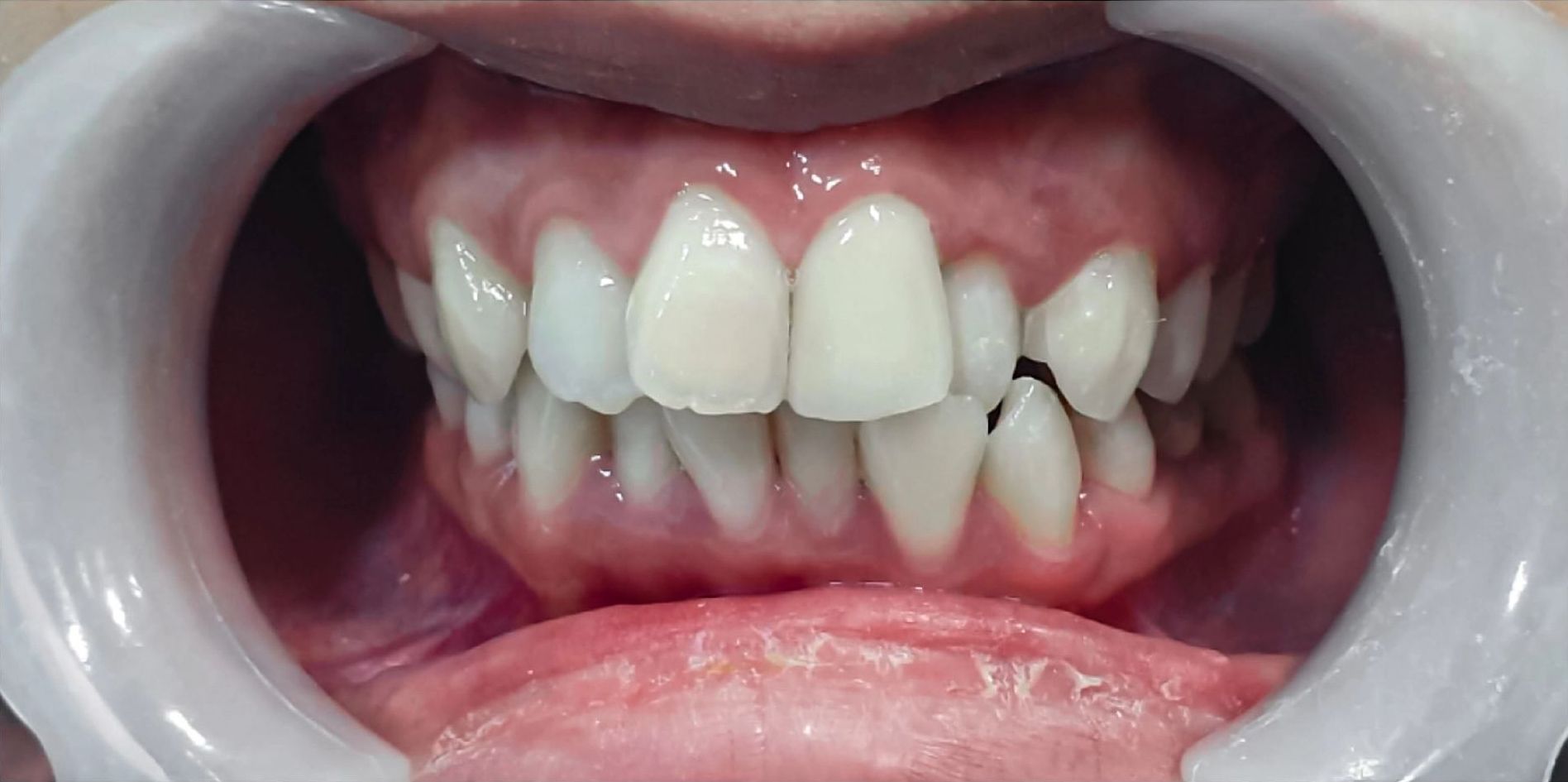 After Image of a Smile with a Fixed Broken Tooth