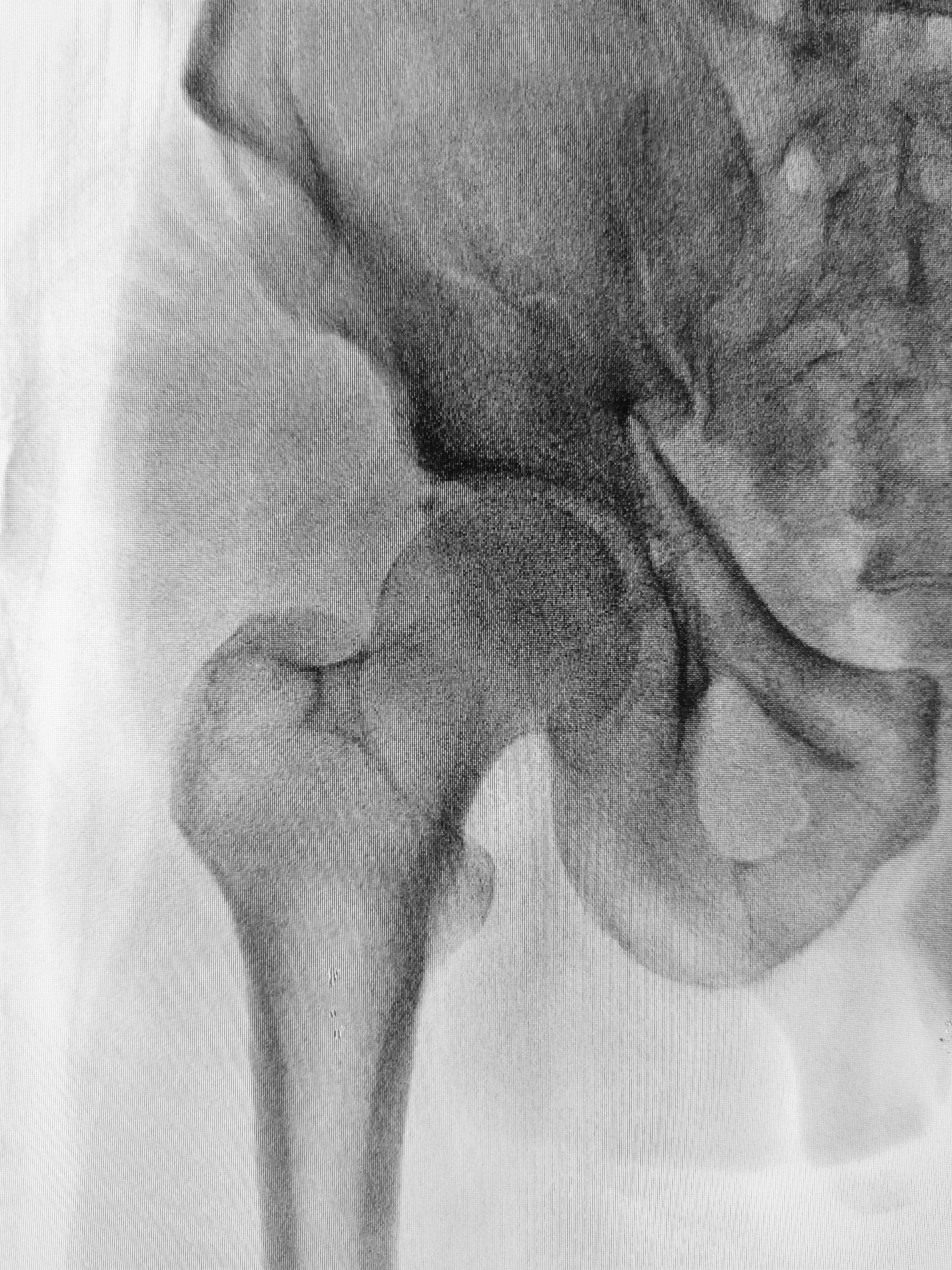 Scan image of hip joint