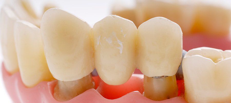 10 FAQs About Dental Bridges in Montclair, CA. 10 FAQs About Dental Bridges in Montclair, CA.