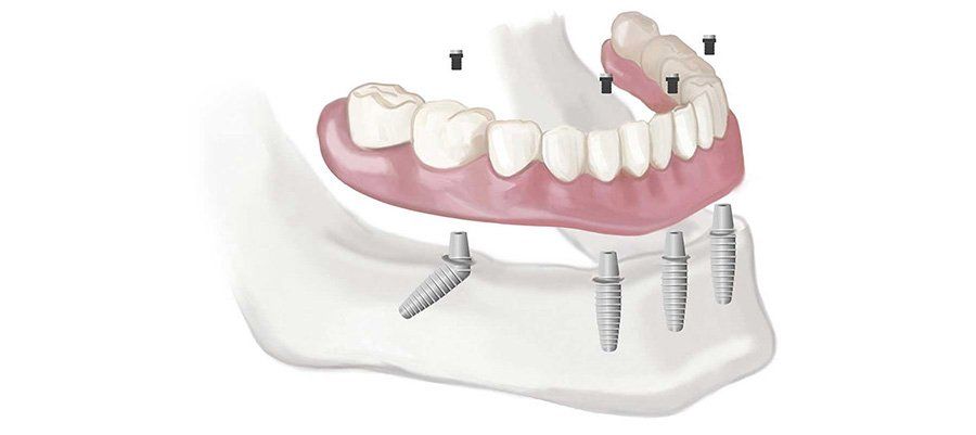 5 Critical Mistakes to Avoid with All-on-4 Treatment Concept 5 Critical Mistakes to Avoid with All-on-4 Treatment Concept