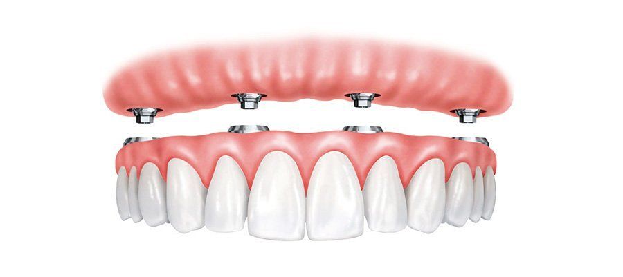 5 Life-Changing Benefits of Teeth in a Day 5 Life-Changing Benefits of Teeth in a Day