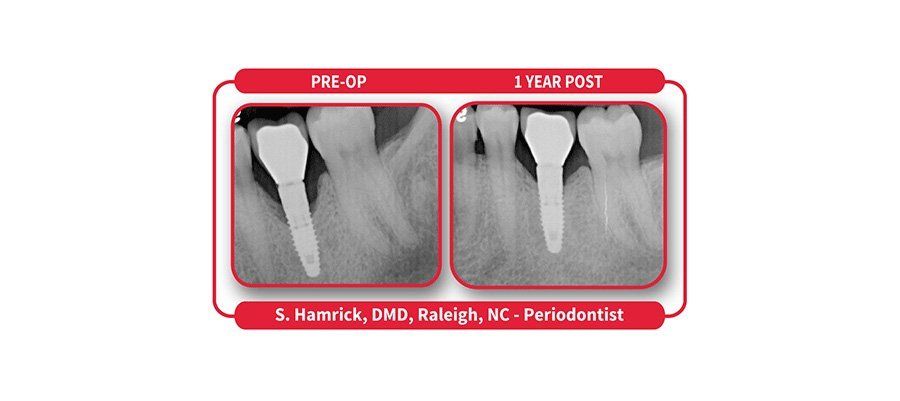 How LANAP and LAPIP Treats Gum Disease and Peri-Implantitis How LANAP and LAPIP Treats Gum Disease and Peri-Implantitis
