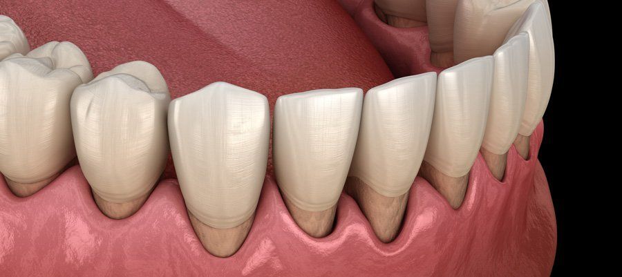 How to Stop Gum Recession: Effective Treatments in CA How to Stop Gum Recession: Effective Treatments in CA