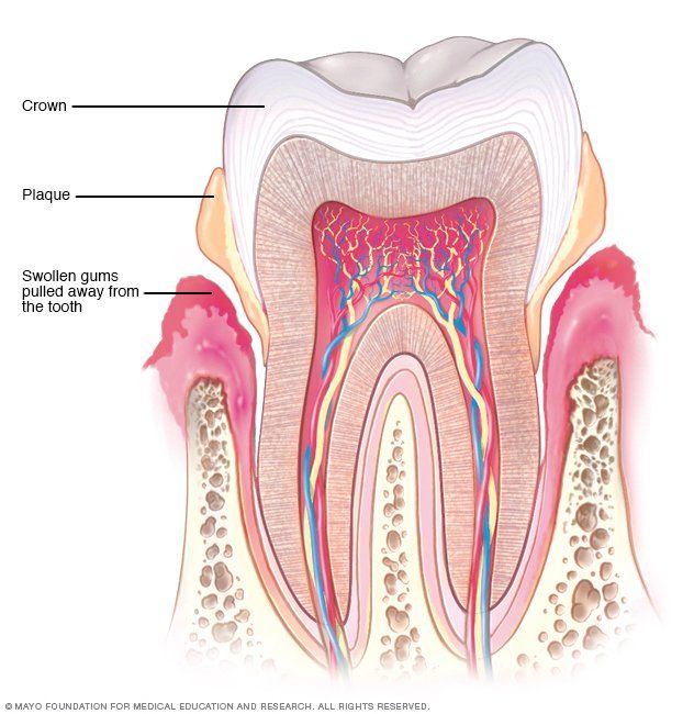 Periodontitis Periodontitis