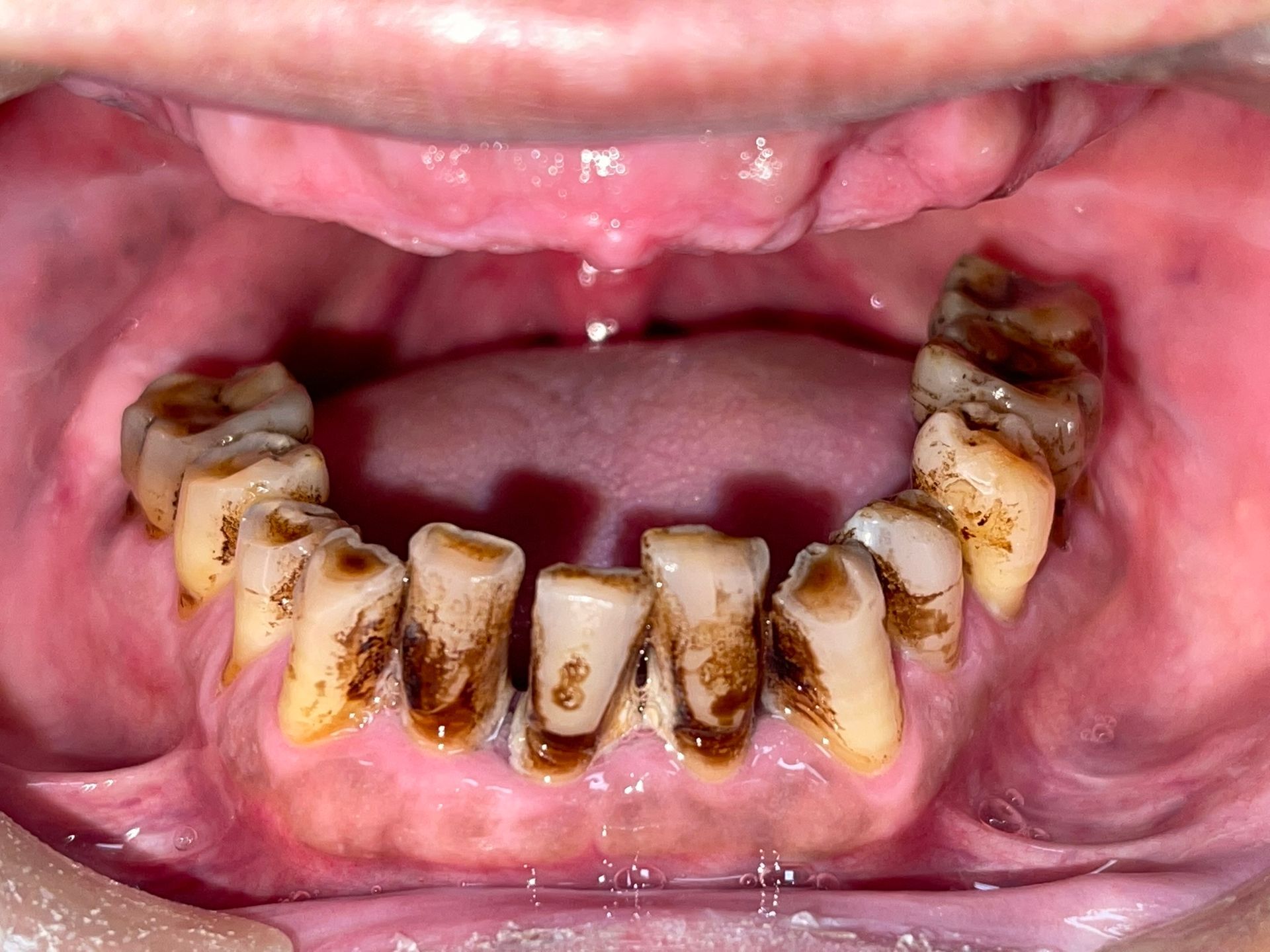 Close-up of lower teeth with severe brown plaque and tartar buildup along the gums