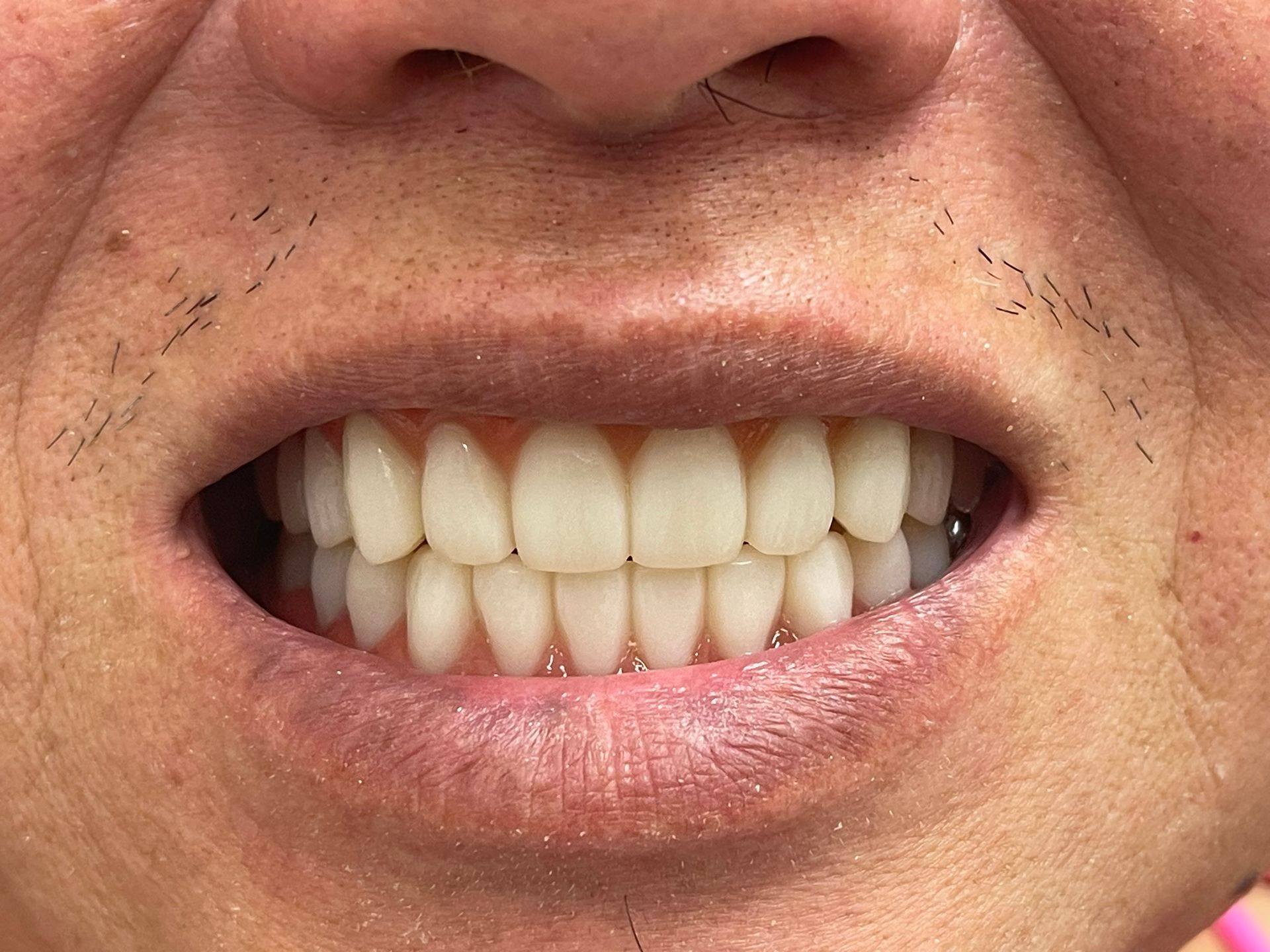 Close-up of a smiling mouth showing teeth and light facial stubble