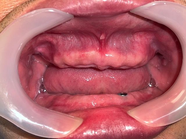 Inside of a mouth held open with retractors, showing the tongue and throat.