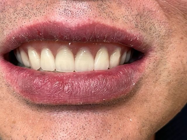 Close-up of a smiling mouth with white teeth and pink lips against a skin-toned background