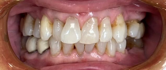 Close-up of teeth and gums, showing crowded, slightly stained front teeth with lips pulled back.