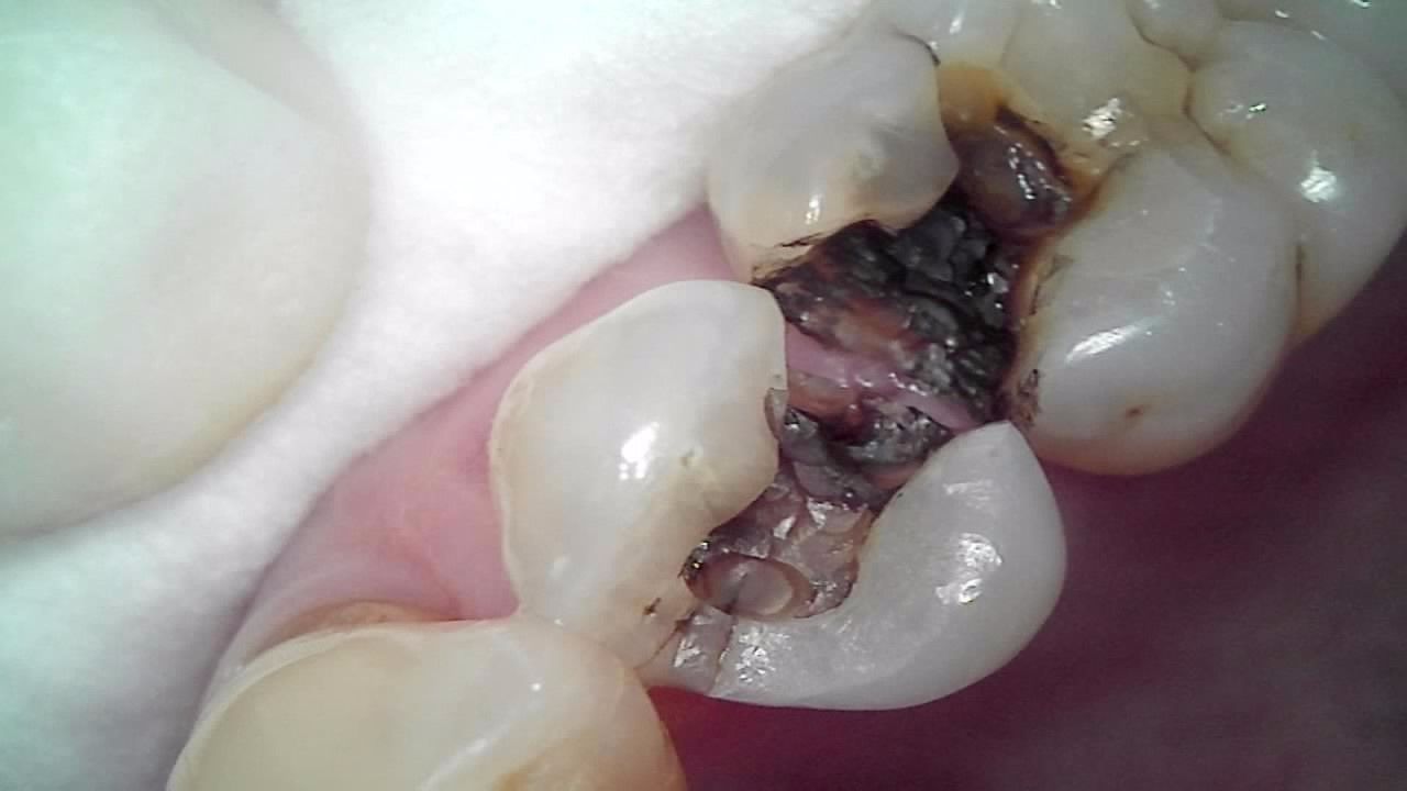Close-up of a decayed molar with a dark cavity and visible dental filling material