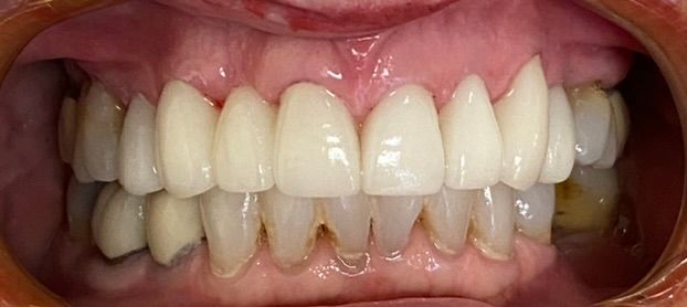 Close-up of a mouth showing a full set of white upper and lower teeth with braces.