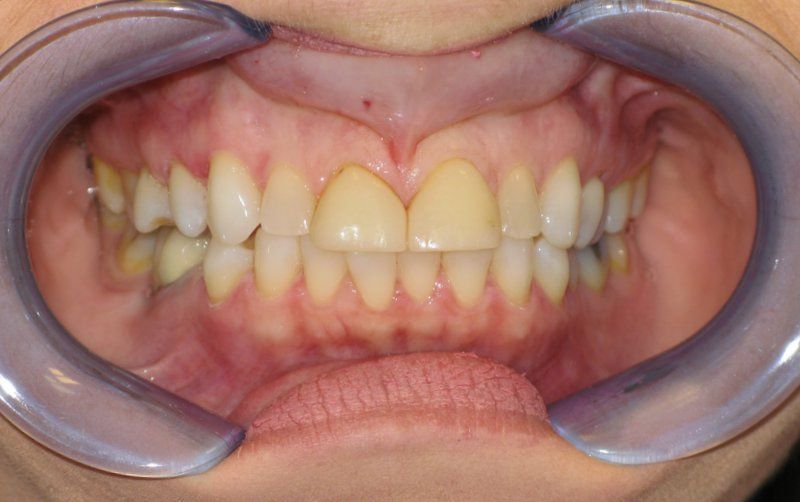 Close-up of teeth and gums with metal cheek retractors in place, showing dental alignment.