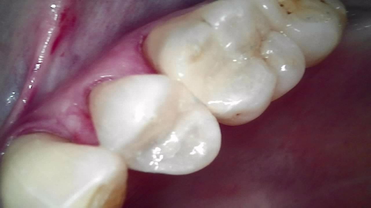 Close-up of molars and gums with pink tissue visible near the back teeth