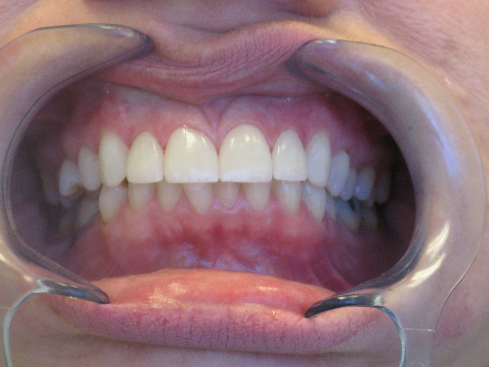 Teeth and gums shown with a cheek retractor during a dental exam