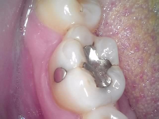 Close-up of a molar with a silver filling and a small pink gum bump nearby