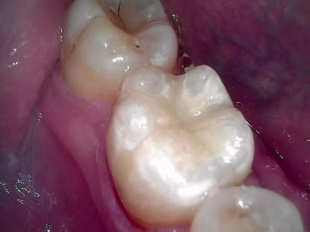 Close-up of a tooth with a white filling and purple gum tissue nearby