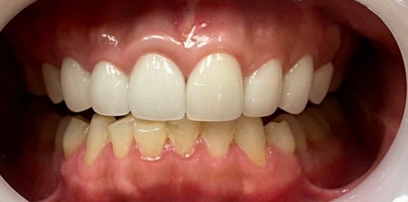 Close-up of a mouth showing teeth with aligned upper teeth and crowded lower front teeth