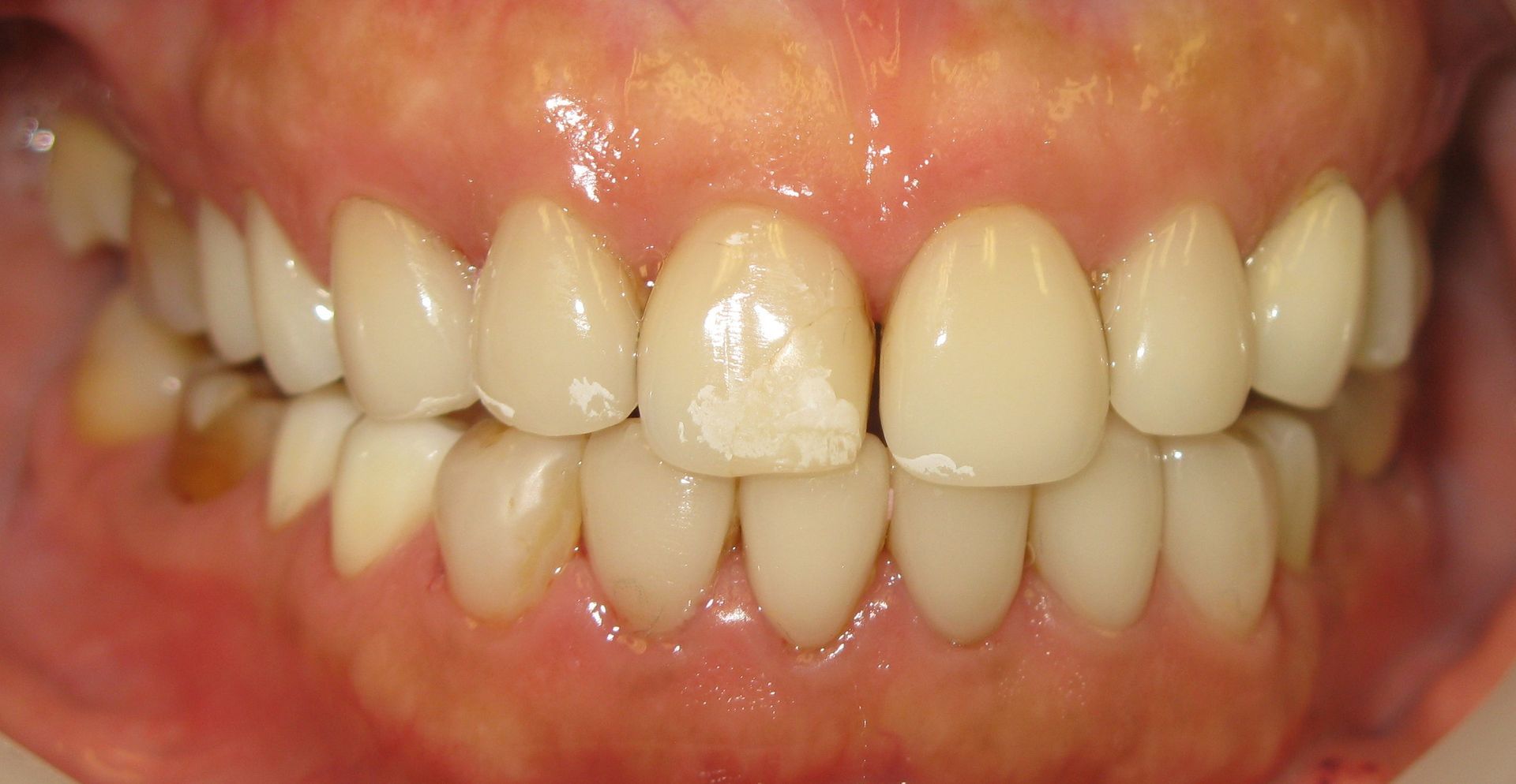 Close-up of teeth with prominent upper front incisors and slight crowding in a mouth smile
