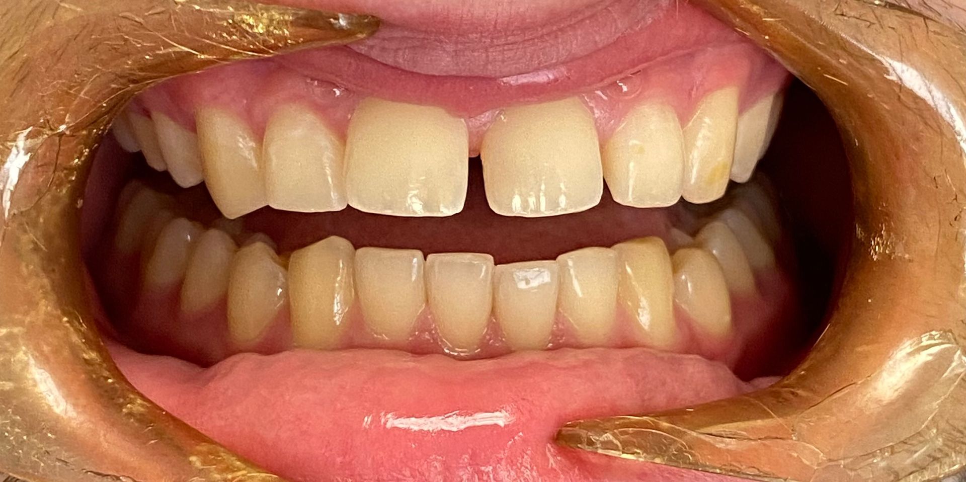 Close-up of a person’s mouth showing upper and lower teeth with lips pulled back
