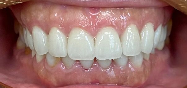 Close-up of a smiling mouth showing bright white teeth and pink gums