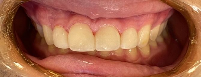 Close-up of a smiling mouth showing teeth and pink gums