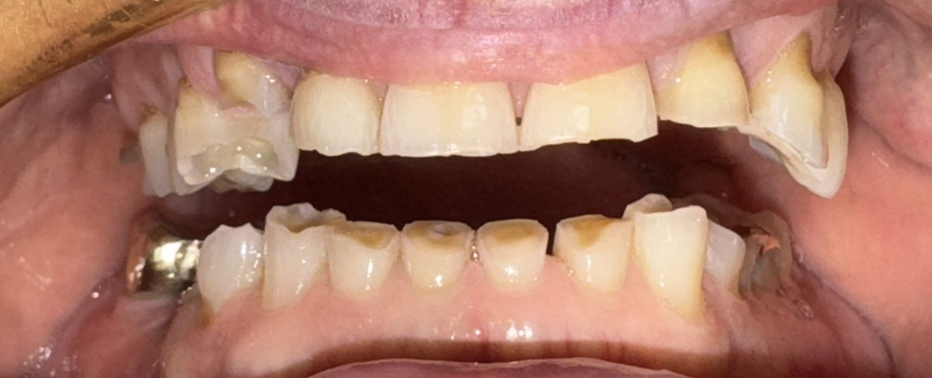 Close-up of an open mouth showing uneven upper and lower teeth with visible dental work.