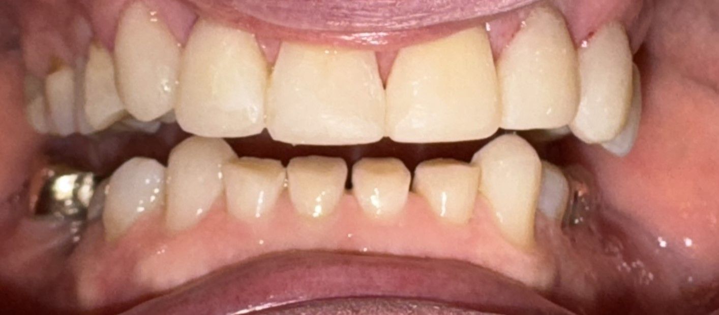 Close-up of a mouth showing upper and lower teeth with braces and visible metal fillings