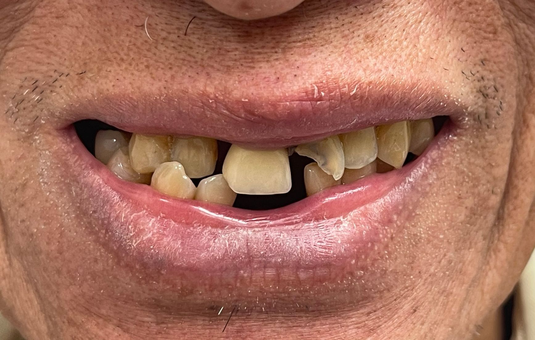 Close-up of a missing-tooth smile with yellowed front teeth and lips slightly parted