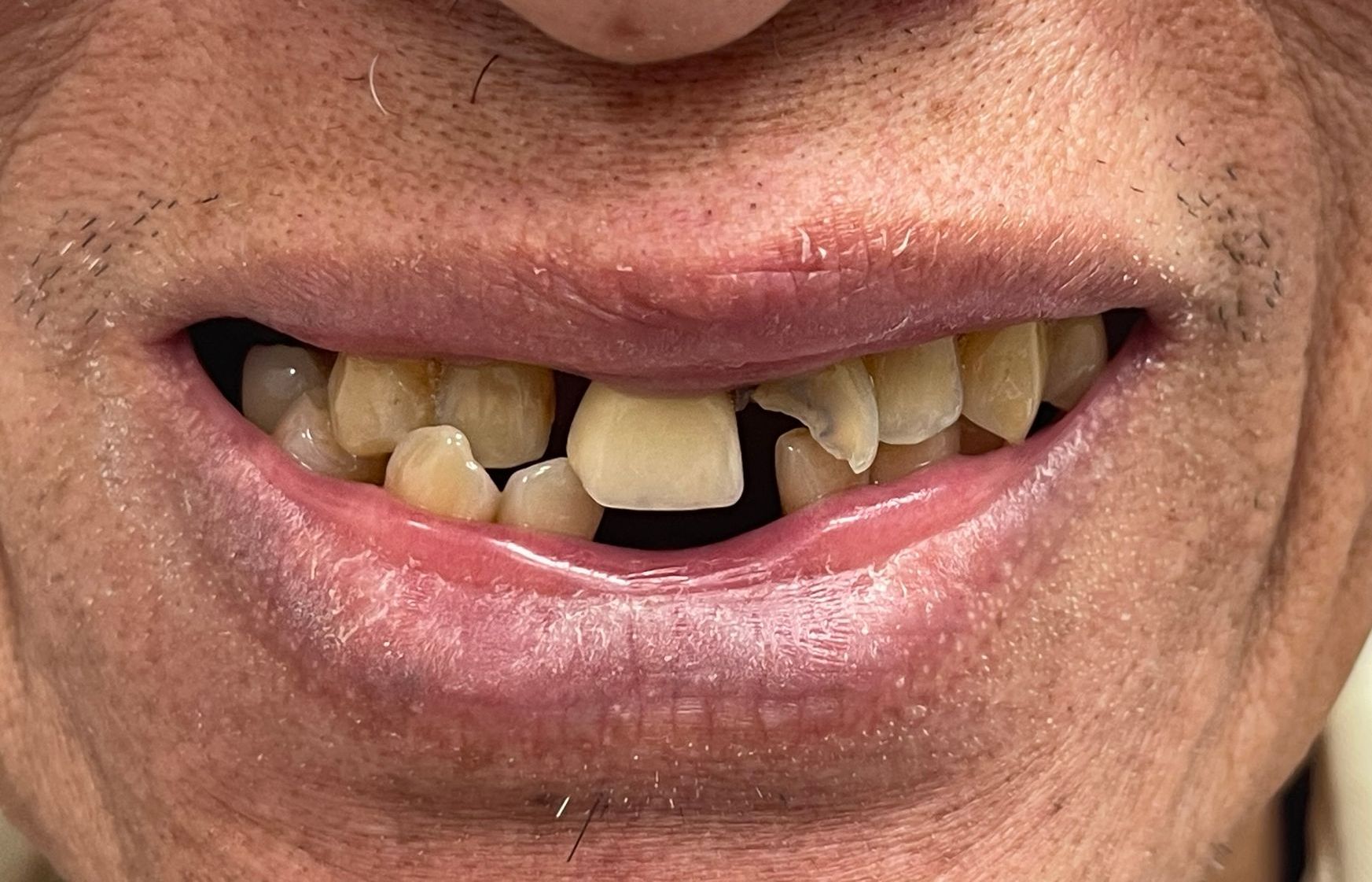 Close-up of a mouth with missing and crooked front teeth and dry, cracked lips