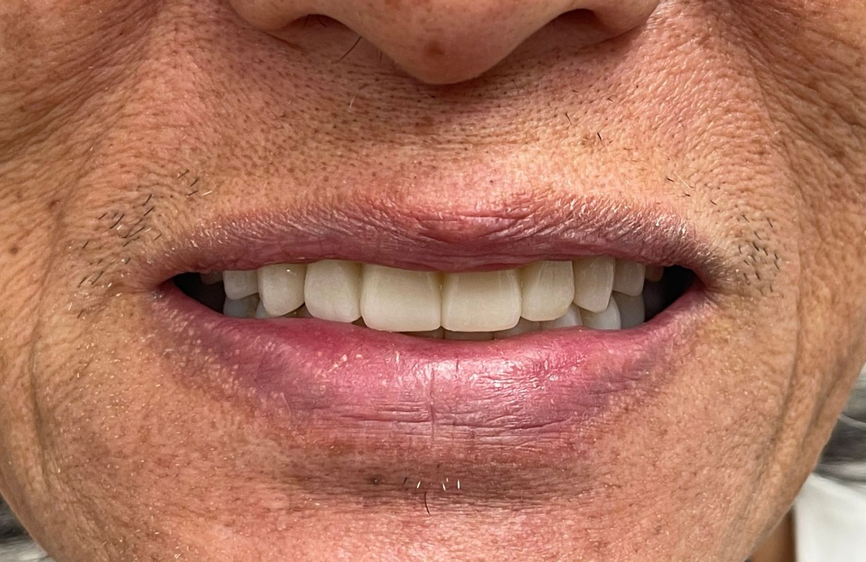 Close-up of a person’s mouth showing stained, crooked front teeth and dry lips