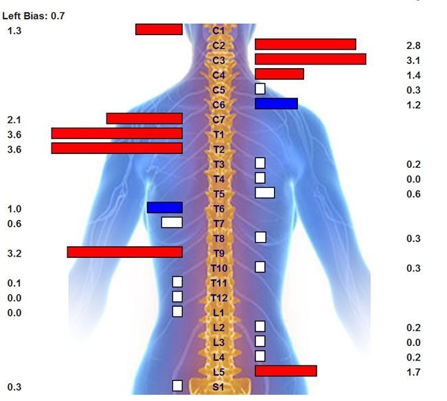 A thermographic scan of a person's spine showing red, blue, and white areas