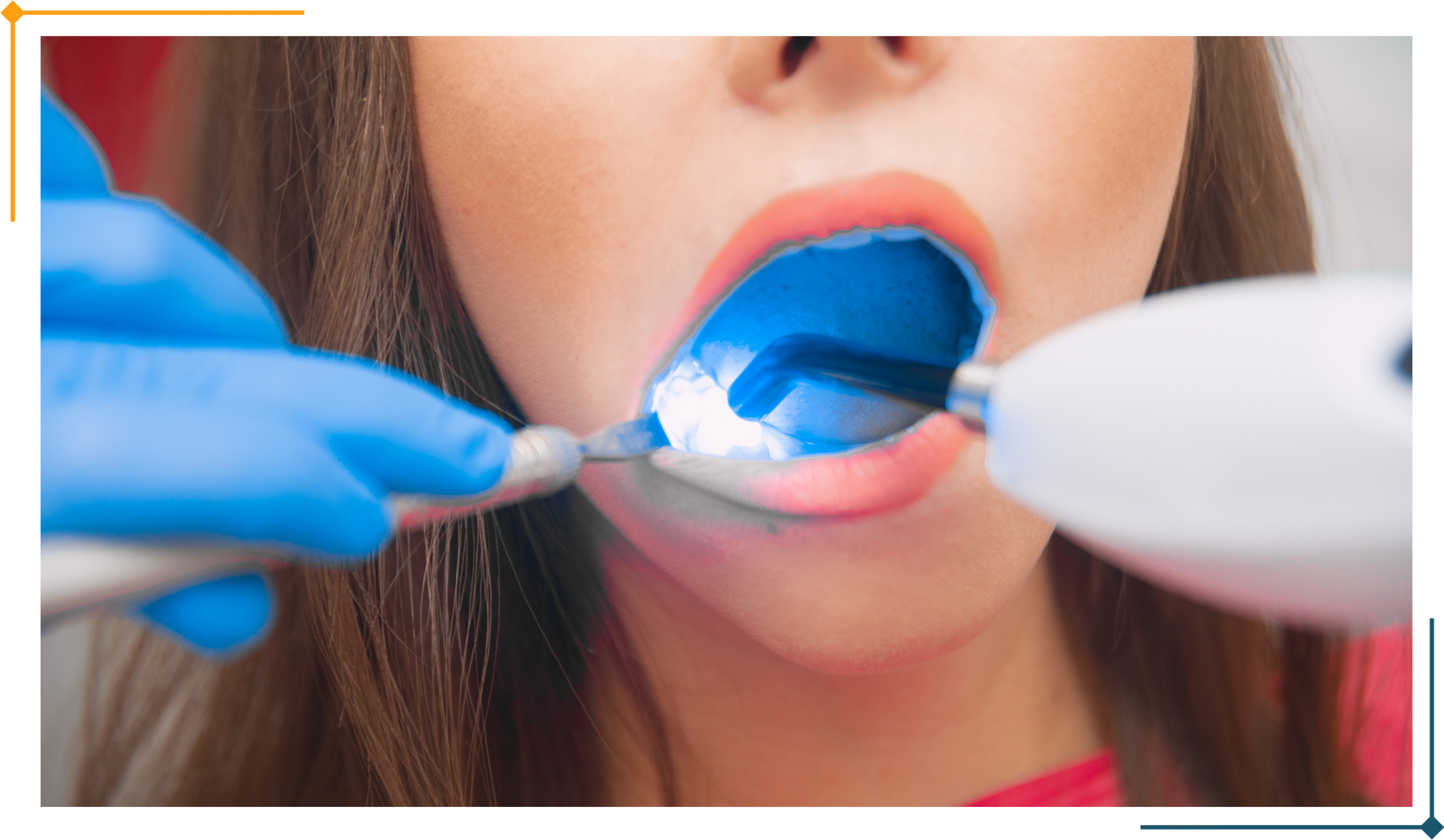 Dentist using curing light on a patient's filled tooth; blue light, mouth open.