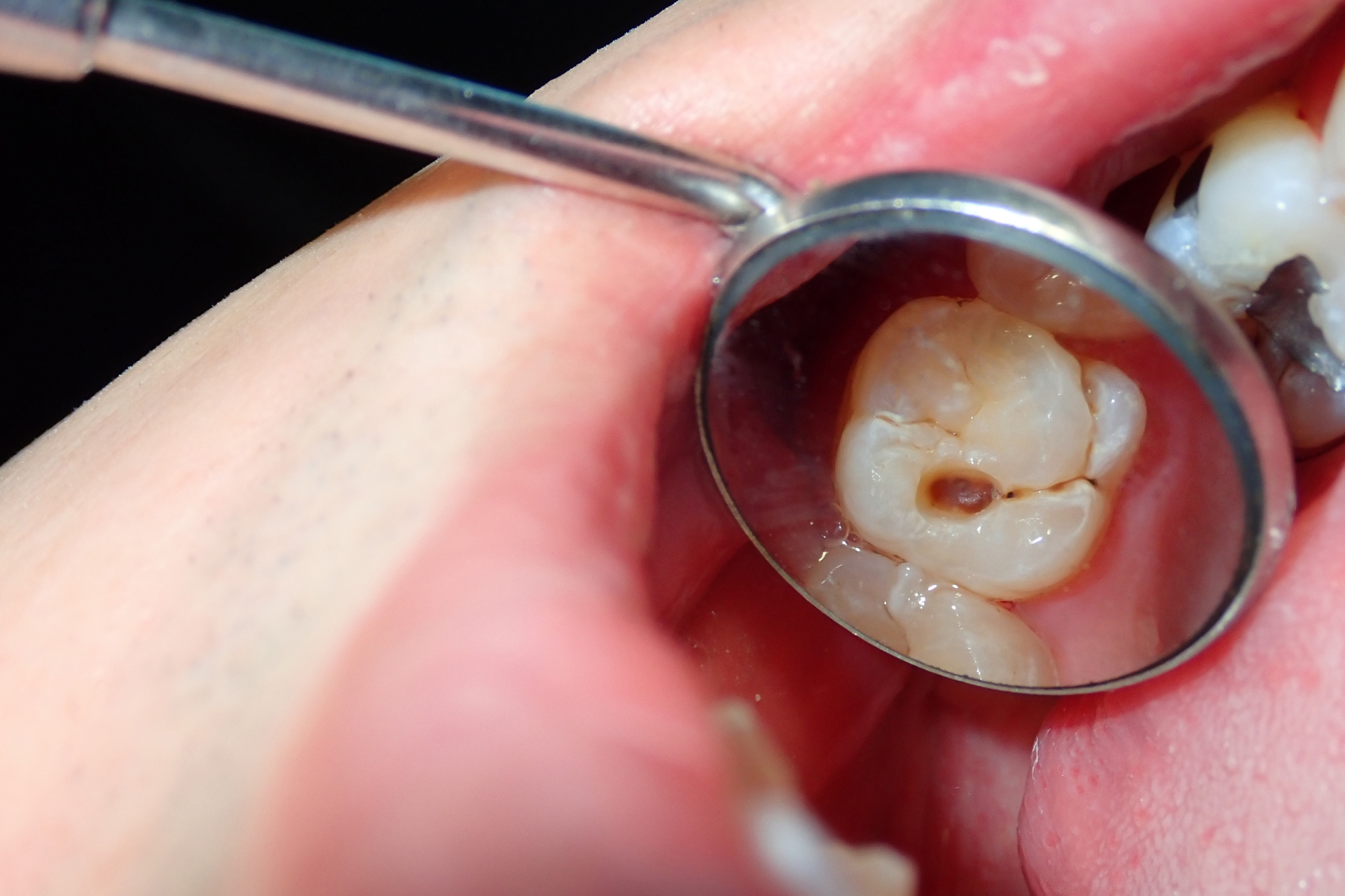 Mouth open, dental mirror showing a molar with a visible cavity and cracks.
