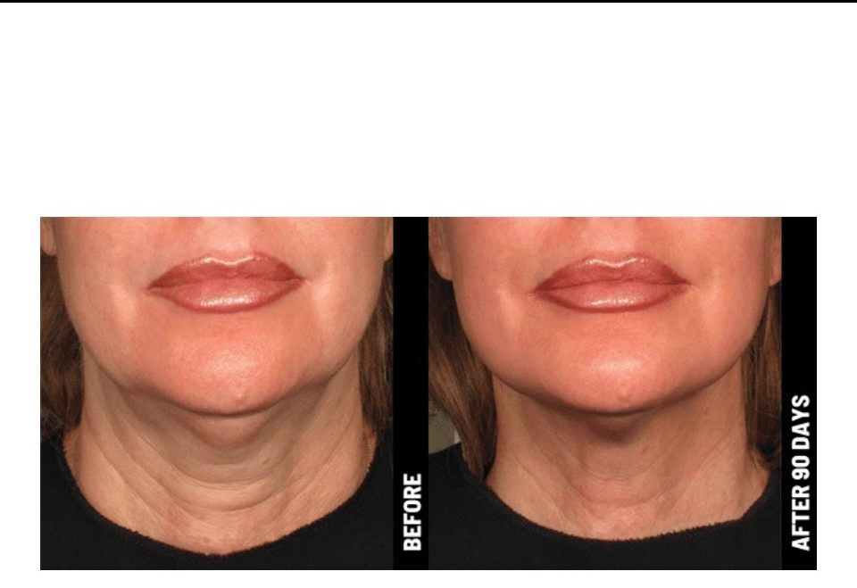 PRP FACELIFT Treatment