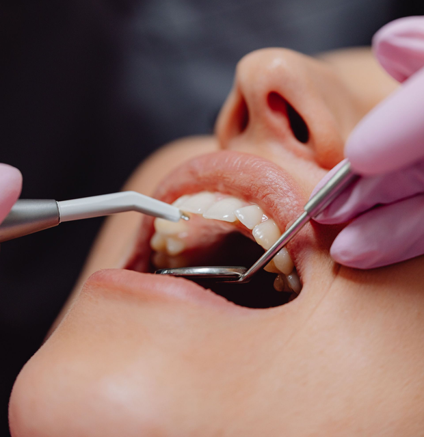 Dentist cleaning a patient’s teeth with a drill and mirror, close-up in a dental clinic