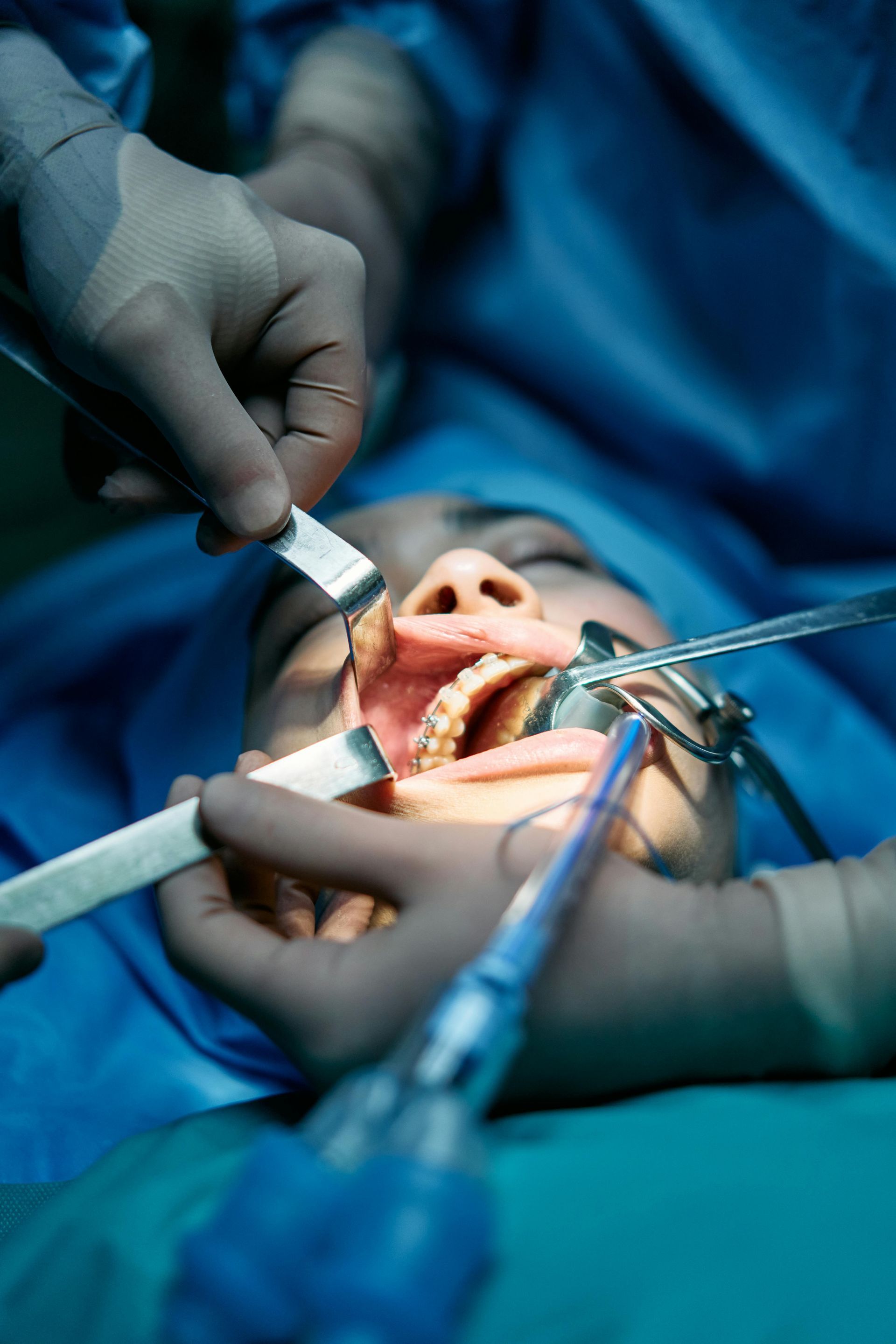 A person's mouth open during dental procedure, with instruments and gloved hands.