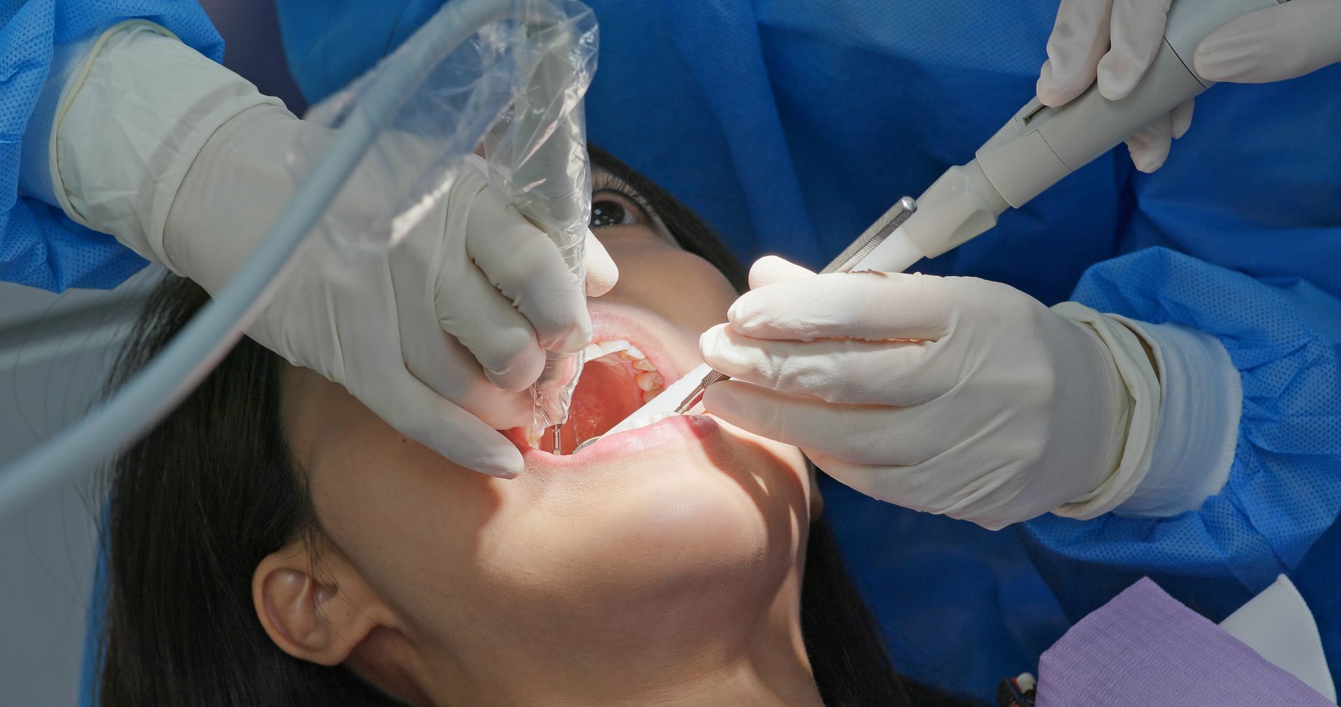 A dental team performing a root canal procedure with instruments.