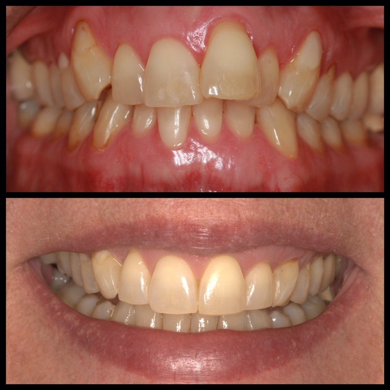 Before and after comparison of a person's misaligned teeth, followed by a straight, white smile.