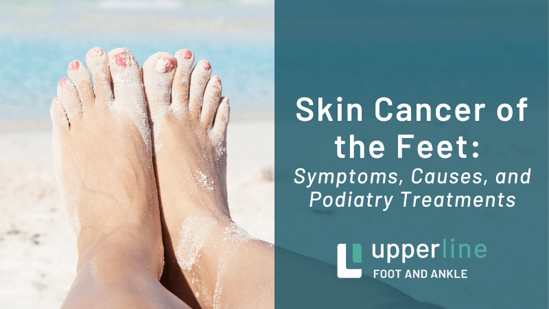 Skin cancer of the feet Skin cancer of the feet