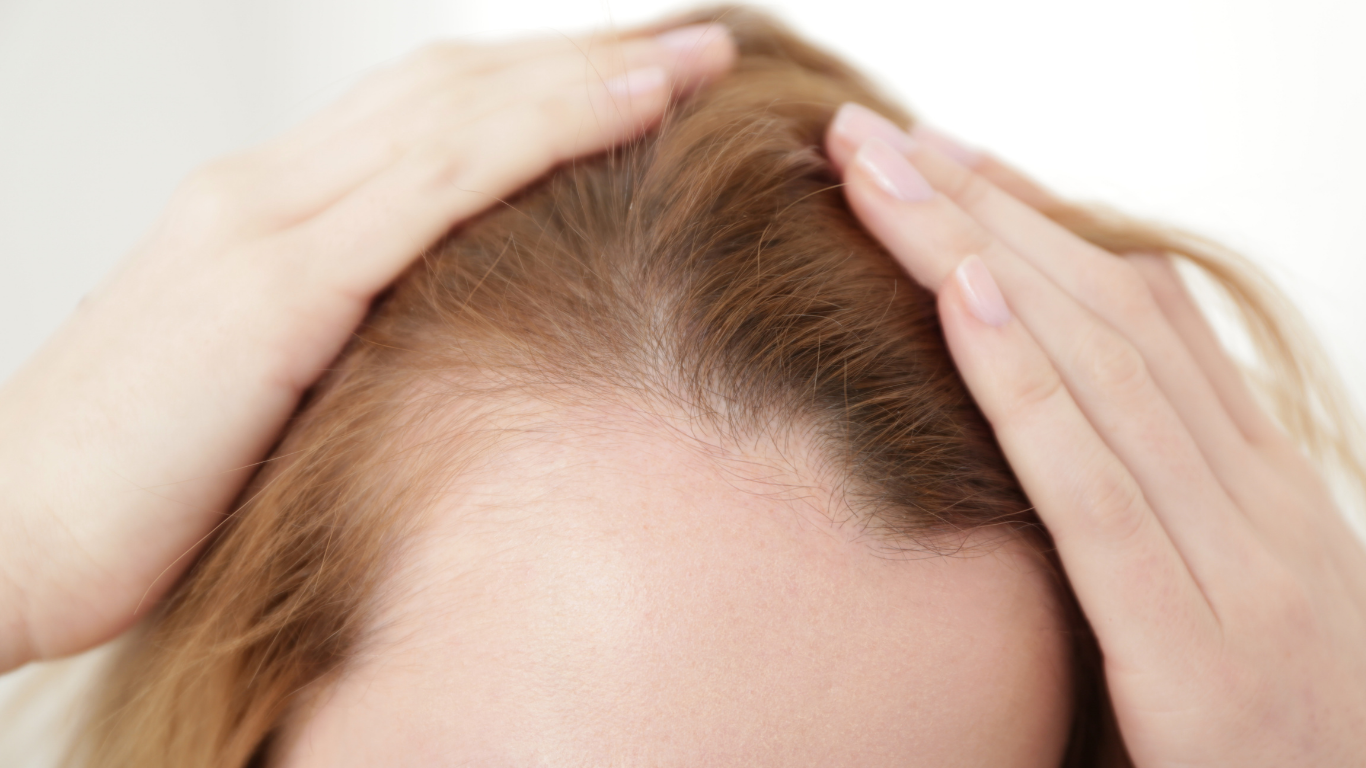 Hands holding the top of a person’s head with hair parting, showing a thinning scalp line