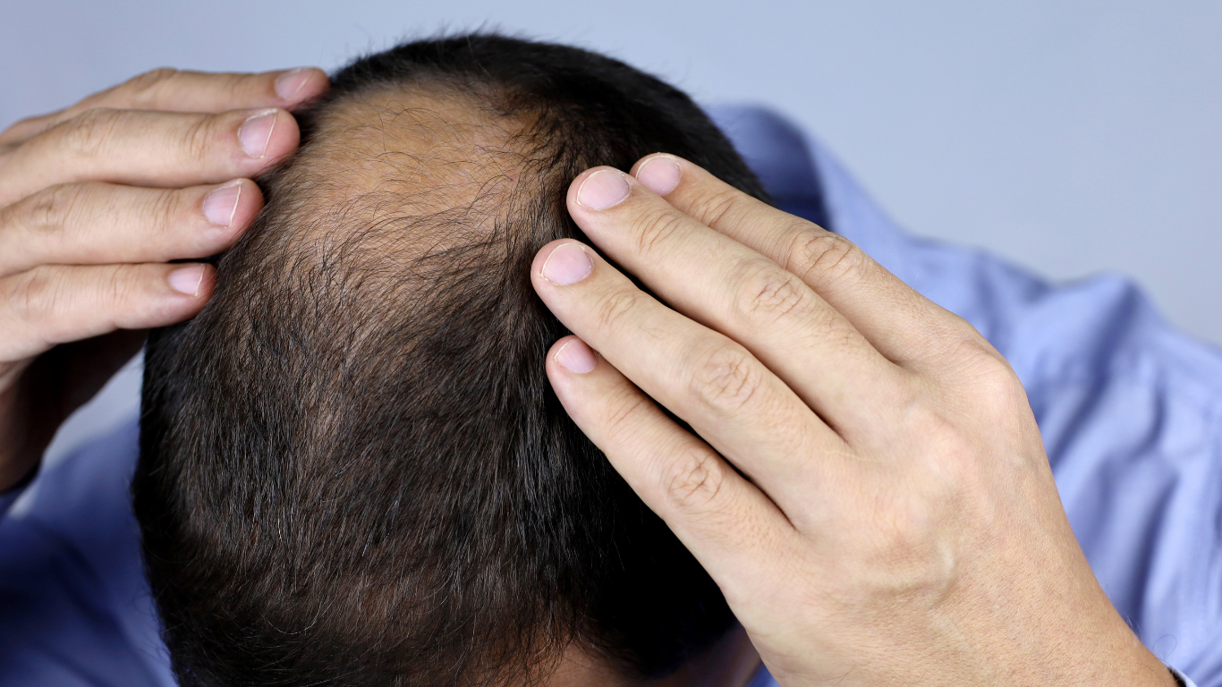 Hands examining a bald spot on the top of a person's head