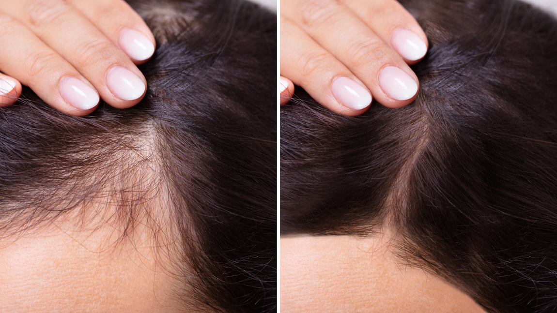 Hands parting dark hair to show a thinning scalp line.