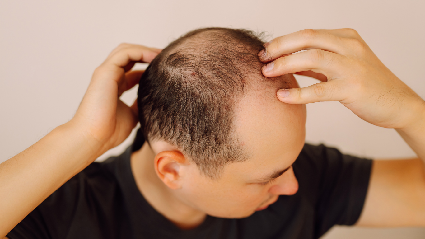 A man looking down and touching his thinning hair with both hands.