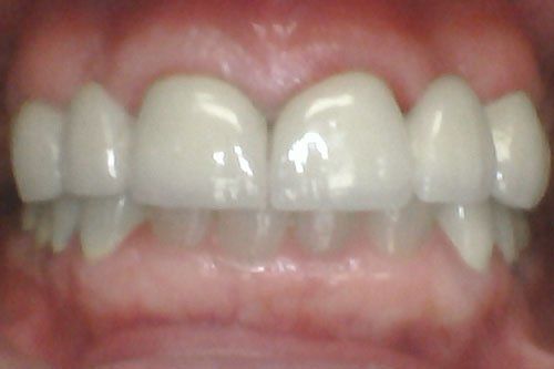 After Treatment