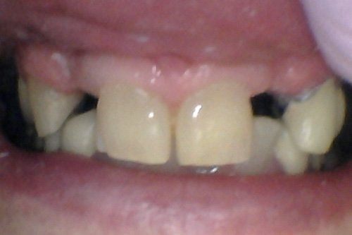Before Treatment