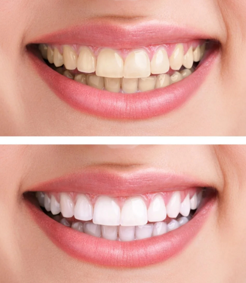 Confronto affiancato: denti gialli contro denti bianchi e brillanti, entrambi in bocche sorridenti, che mostrano l'effetto sbiancante dei denti.