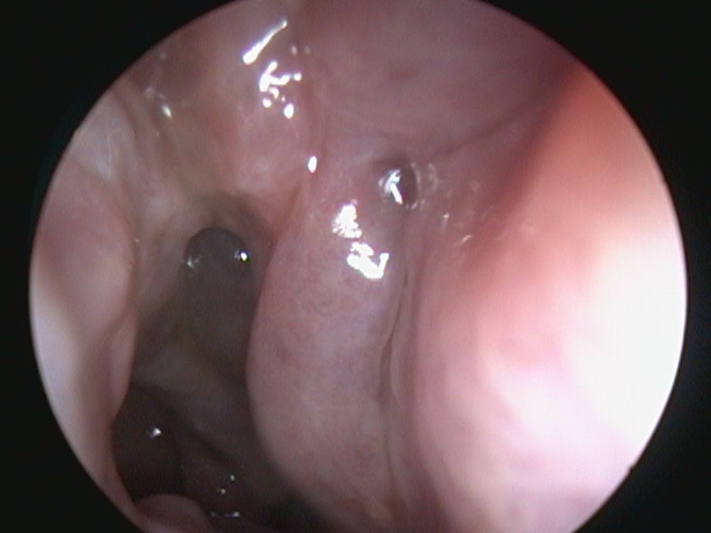 nasal polyps