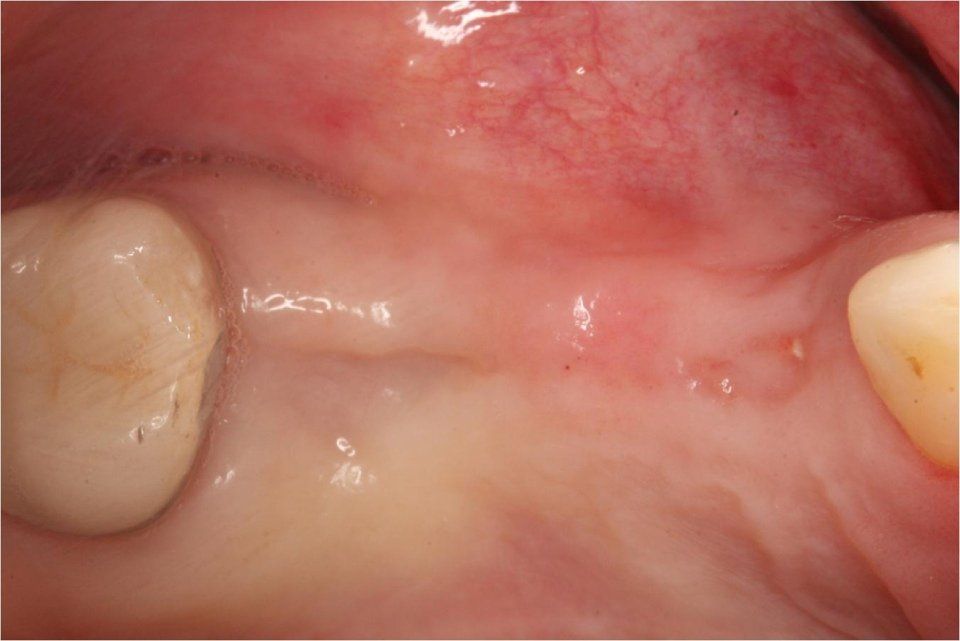 Primo piano delle gengive e dei denti di una persona, che mostrano l'infiammazione e alcune piccole protuberanze.