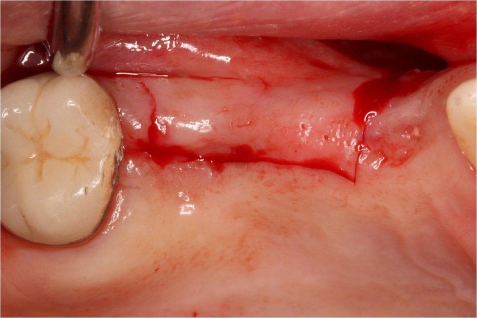 Vista chirurgica di una procedura odontoiatrica: un'incisione sanguinante sulla gengiva, vicino a un molare, con uno strumento odontoiatrico presente.