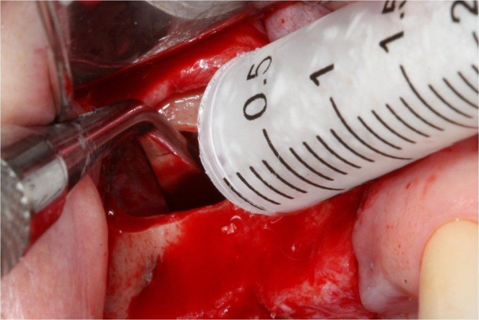 Intervento chirurgico dentale con iniezione tramite siringa nella zona gengivale sanguinante.